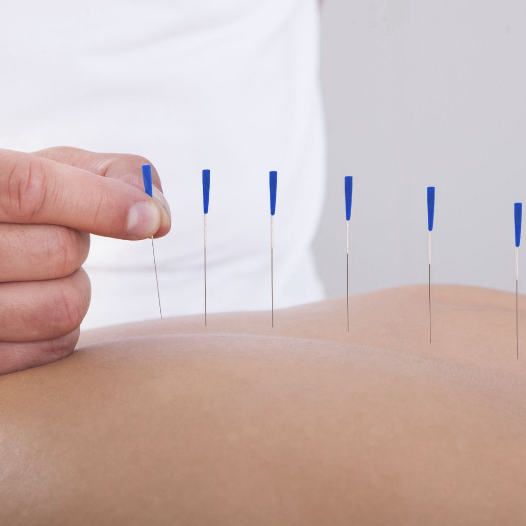 acupuncture-pain-relief
