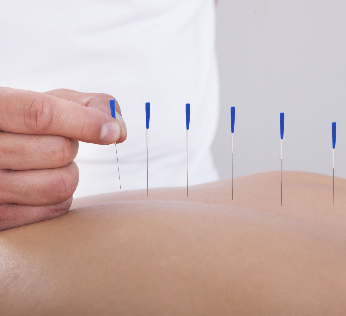 acupuncture-pain-relief