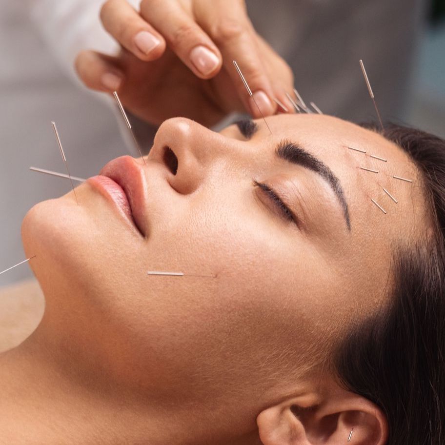 acupuncture_2